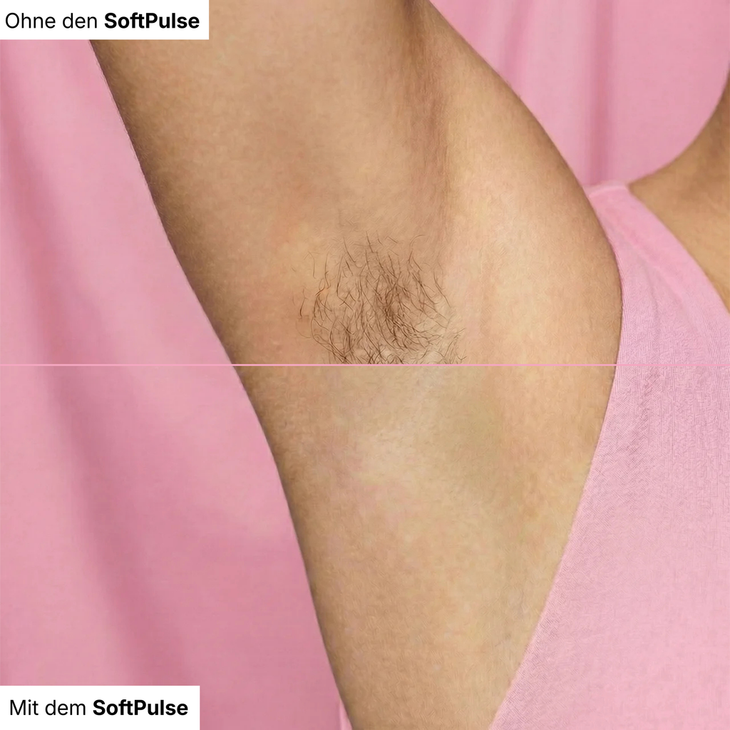 Baleva SoftPulse I Der IPL Haarentferner