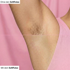 Baleva SoftPulse I Der IPL Haarentferner